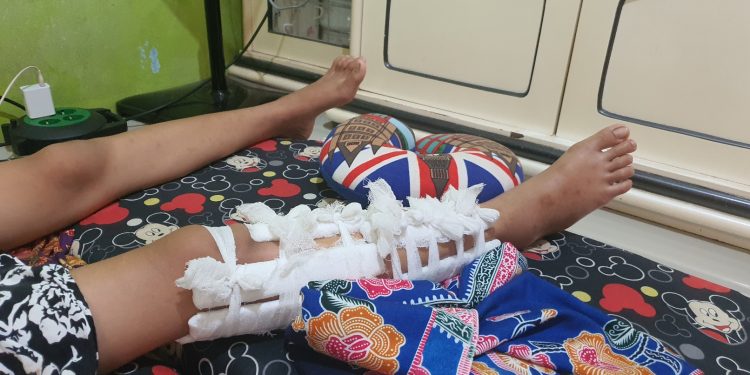 Siswi di Tangerang Jadi Korban Bullying hingga Patah Kaki, Kini Terbaring Lemas