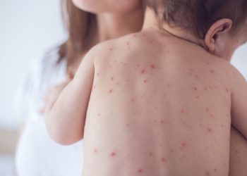 Cegah Penyebaran Campak, Pemkot Tangsel Genjot Imunisasi 109 Ribu Anak