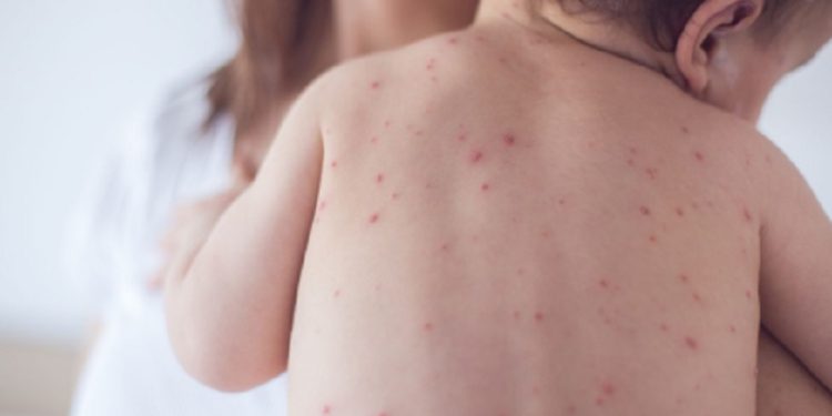 Cegah Penyebaran Campak, Pemkot Tangsel Genjot Imunisasi 109 Ribu Anak